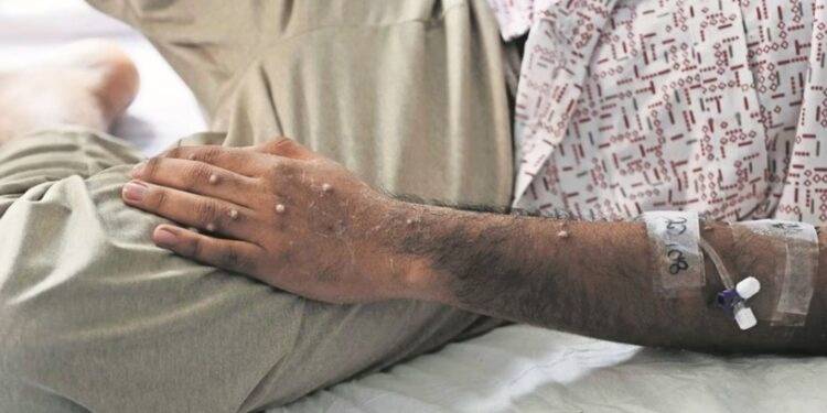 OMS levanta emergencia internacional por la viruela del mono