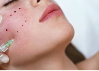 ¿Qué son los «faciales vampiro» y por qué hay tres casos de VIH vinculados a estos tratamientos en EE.UU.?