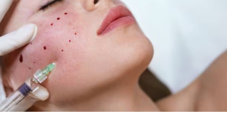 ¿Qué son los «faciales vampiro» y por qué hay tres casos de VIH vinculados a estos tratamientos en EE.UU.?