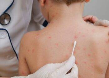 Mantiene Coahuila alerta por sarampión en Texas